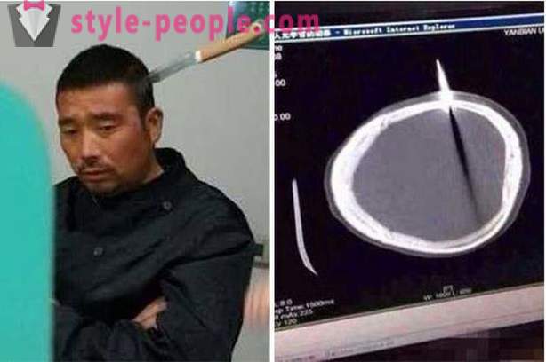 Kitajski moški z nožem v glavi je šel k zdravniku