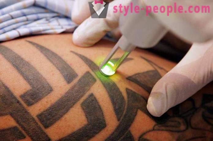 Lasersko odstranitev tatoo. pregledati
