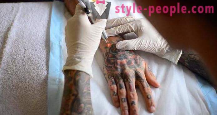 Lasersko odstranitev tatoo. pregledati